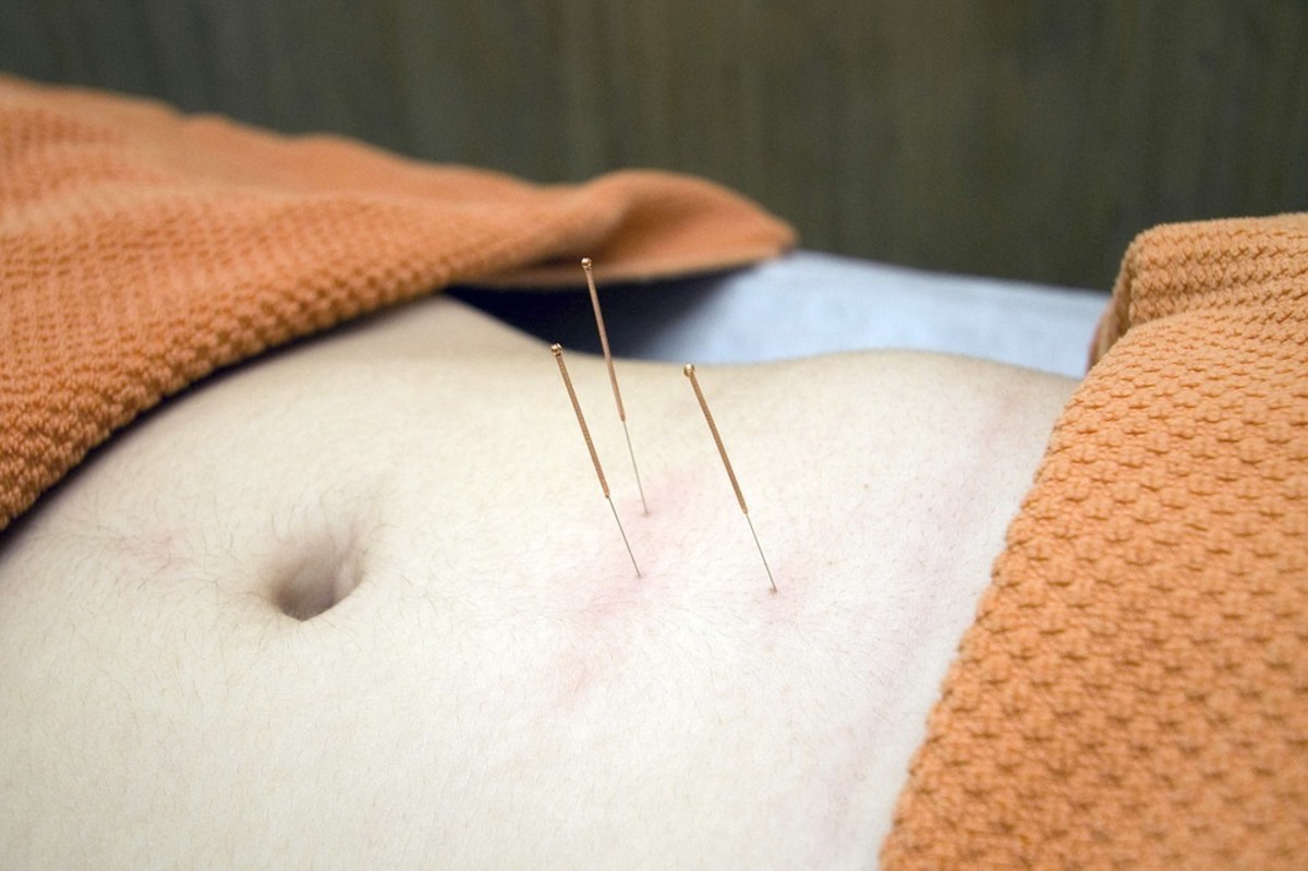 Good Solid Advice About Acupuncture That Anyone Can Use