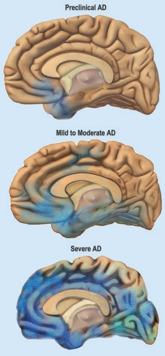 Stages of Alzheimer's Disease