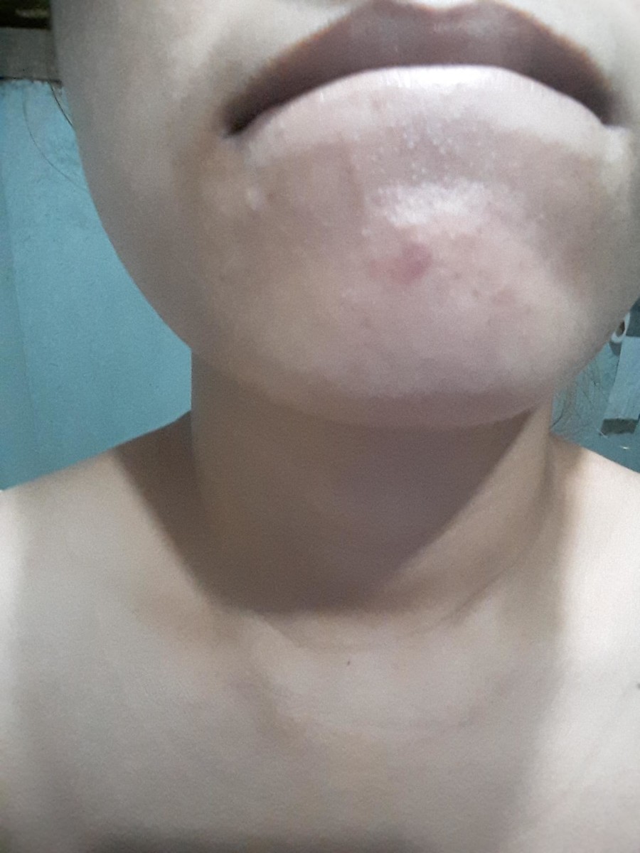 My chin after a week of using elujai propolis.