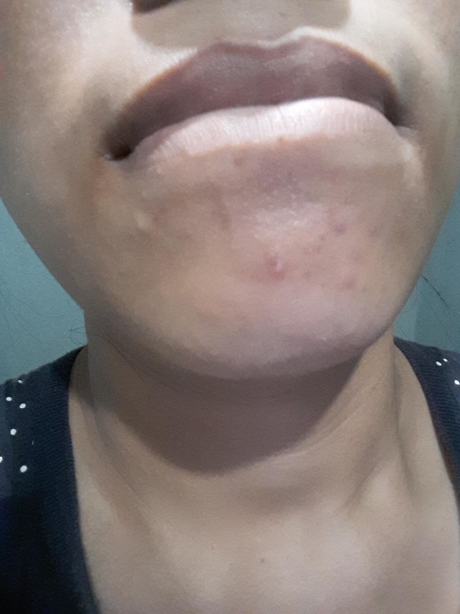 My pimple and dark spots, before using elujai.