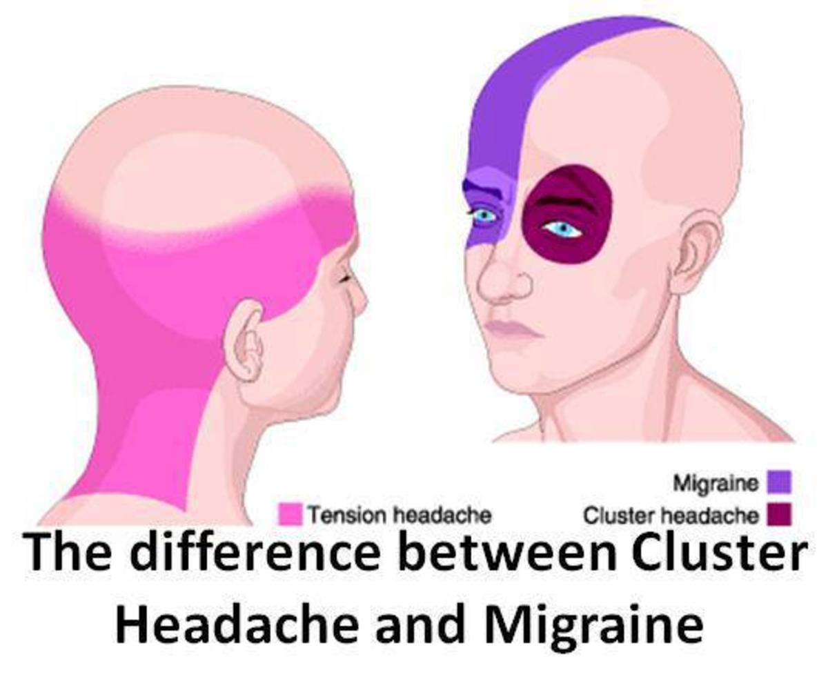 cluster-headache-characteristics