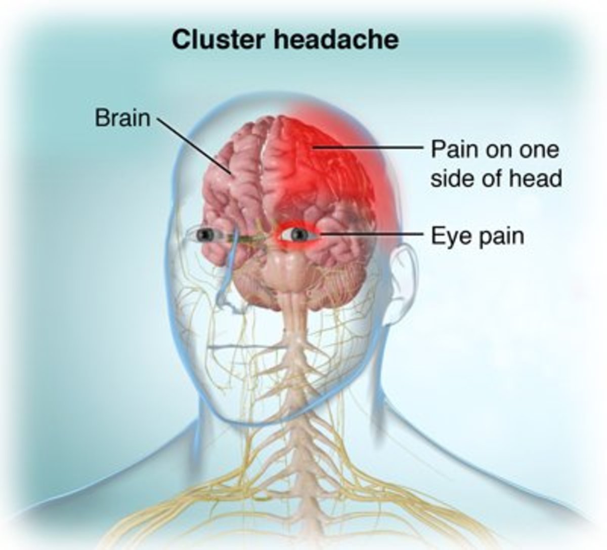 cluster-headache-characteristics