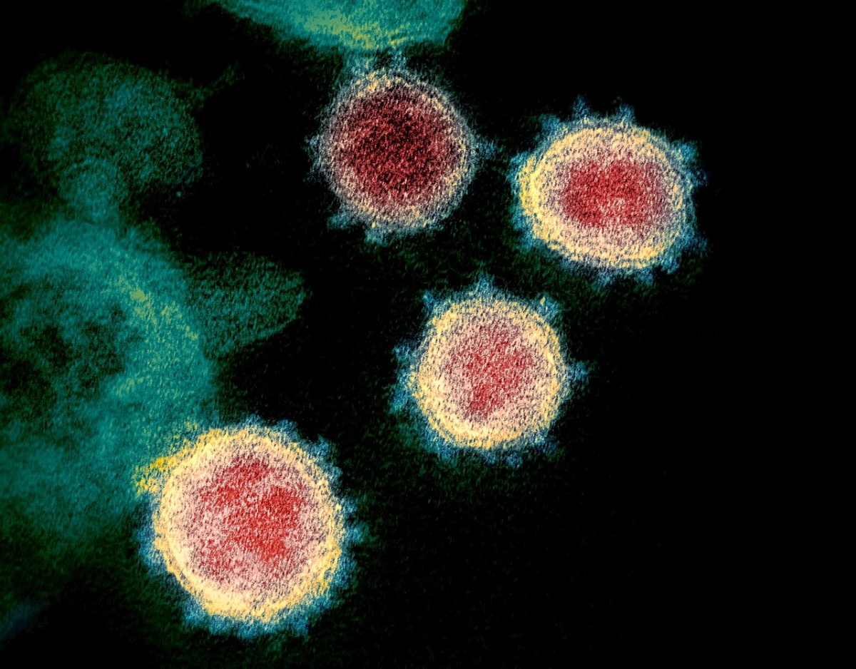 A colourized transmission electron microscope image of the SARS-CoV-2 virus obtained from a patient