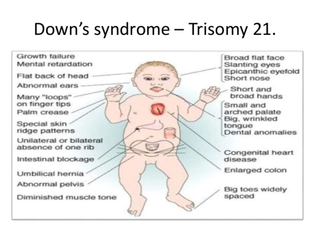 Down Syndrome characteristics