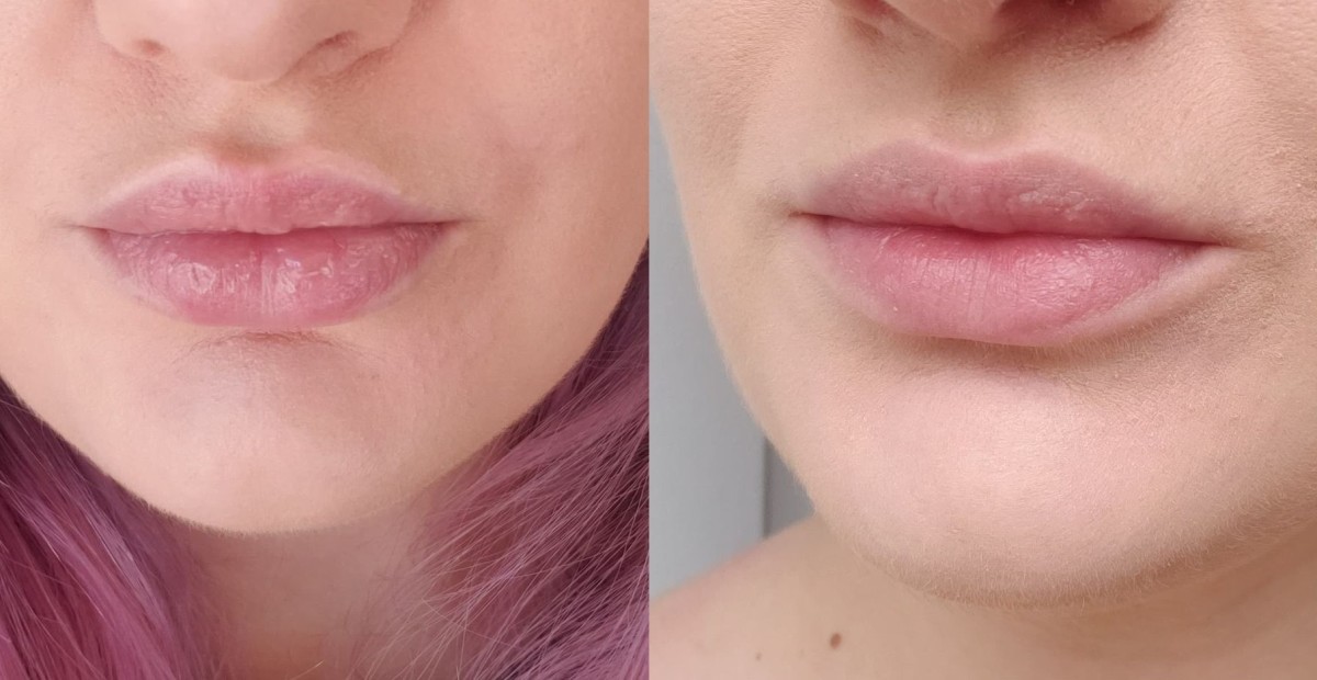 As you can see in the left photo, my lips were looking ROUGH. The right photo was taken literally one day after.
