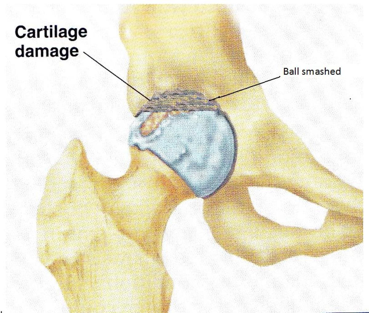 Photo of a hip joint with worn cartilage. 