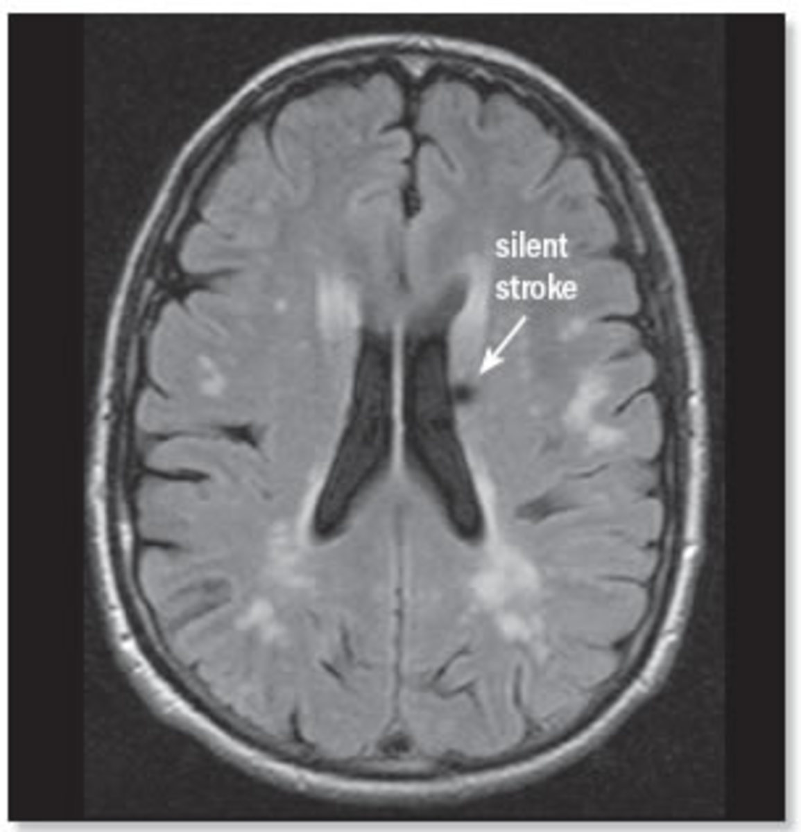 silent-stroke-facts