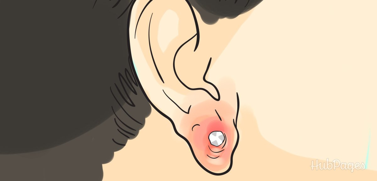 An infected earlobe is painful, but do not take the piercing out—first call your doctor