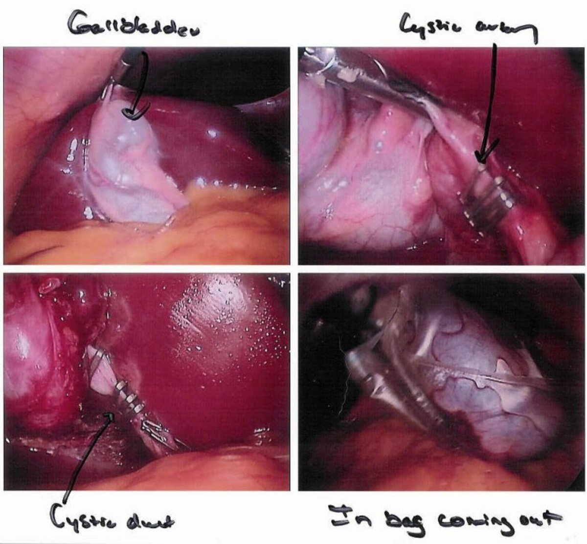 Gallbladder Operation