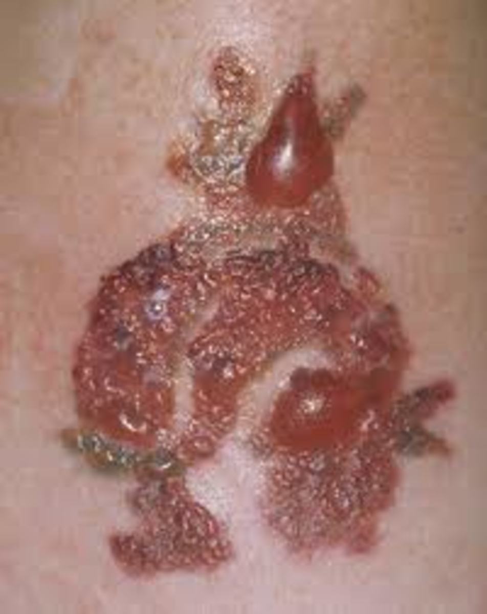 Infected Tattoo The Signs Of Infection  How To Heal