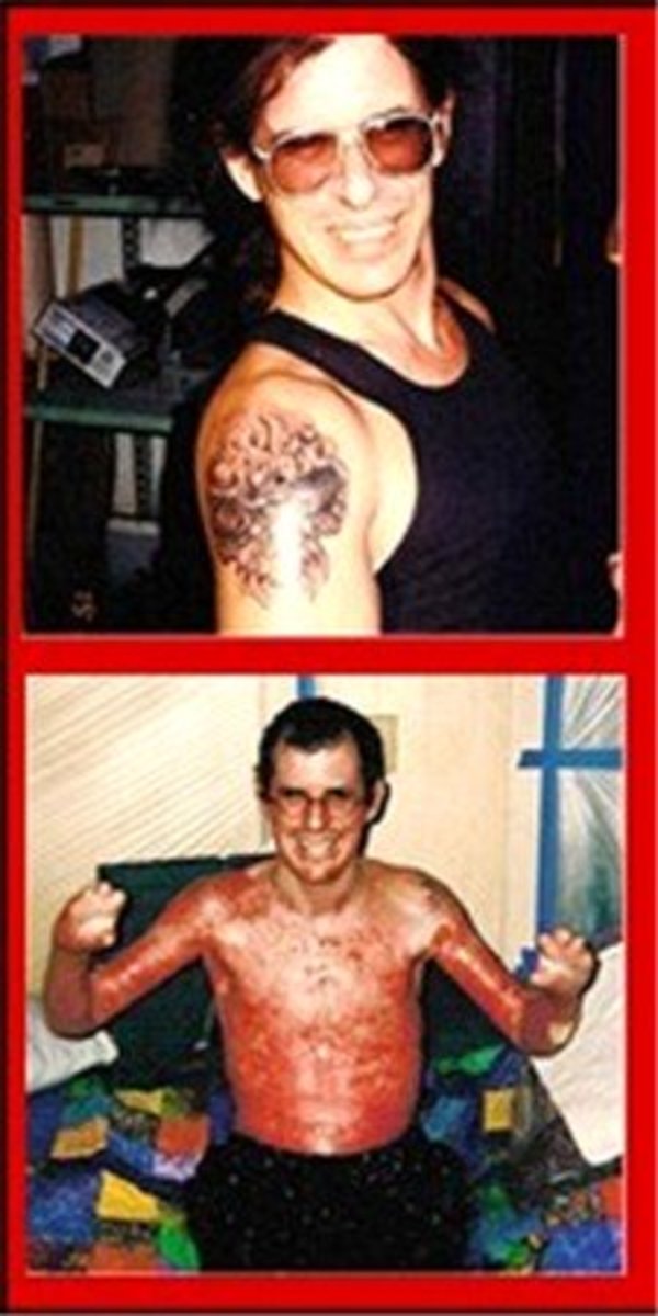 tattoo-burn-scars