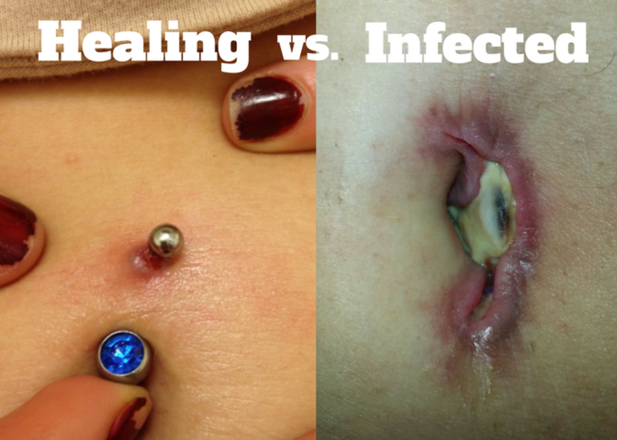 Infected Belly Button Piercing 