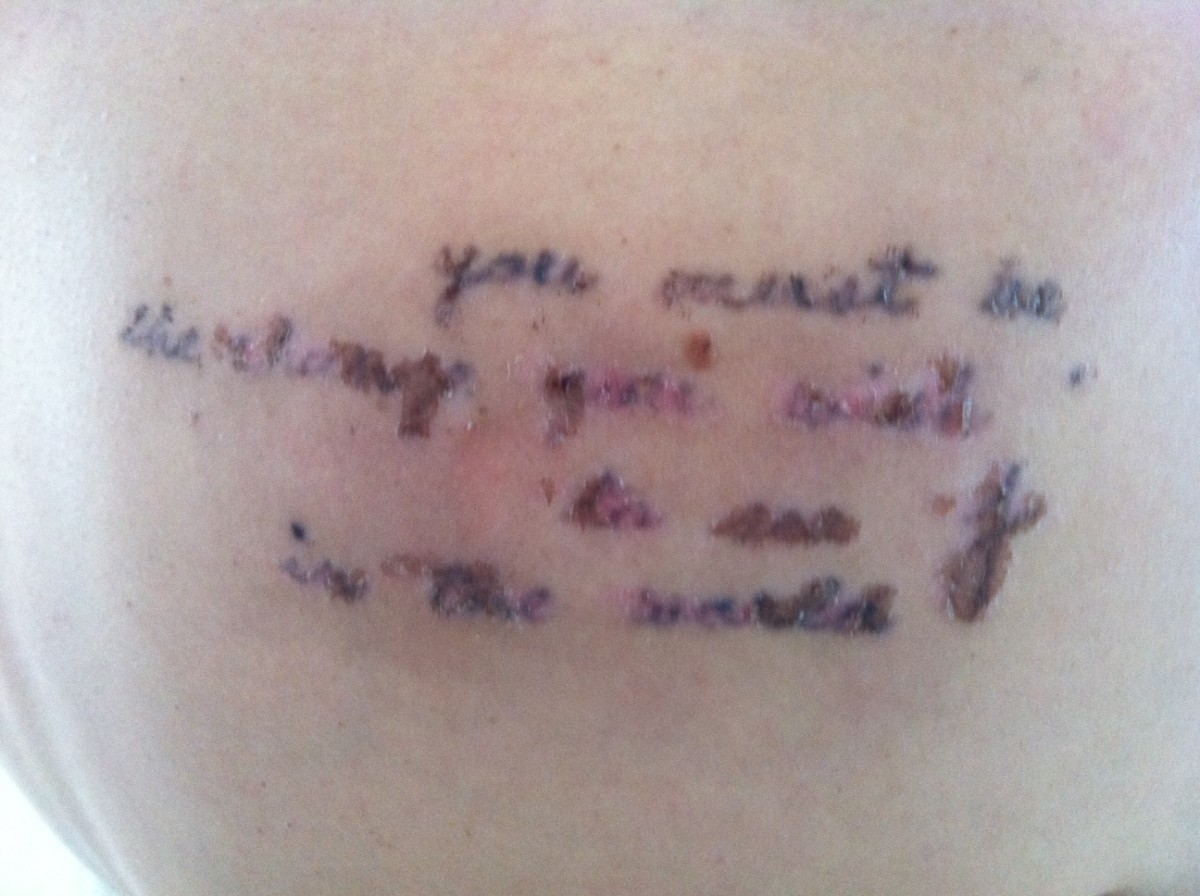 My Tattoo Removal Story, With Photos - TatRing