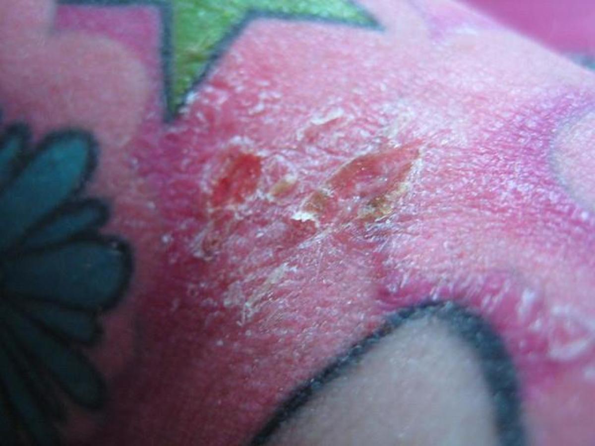 Infected sores on tattoo