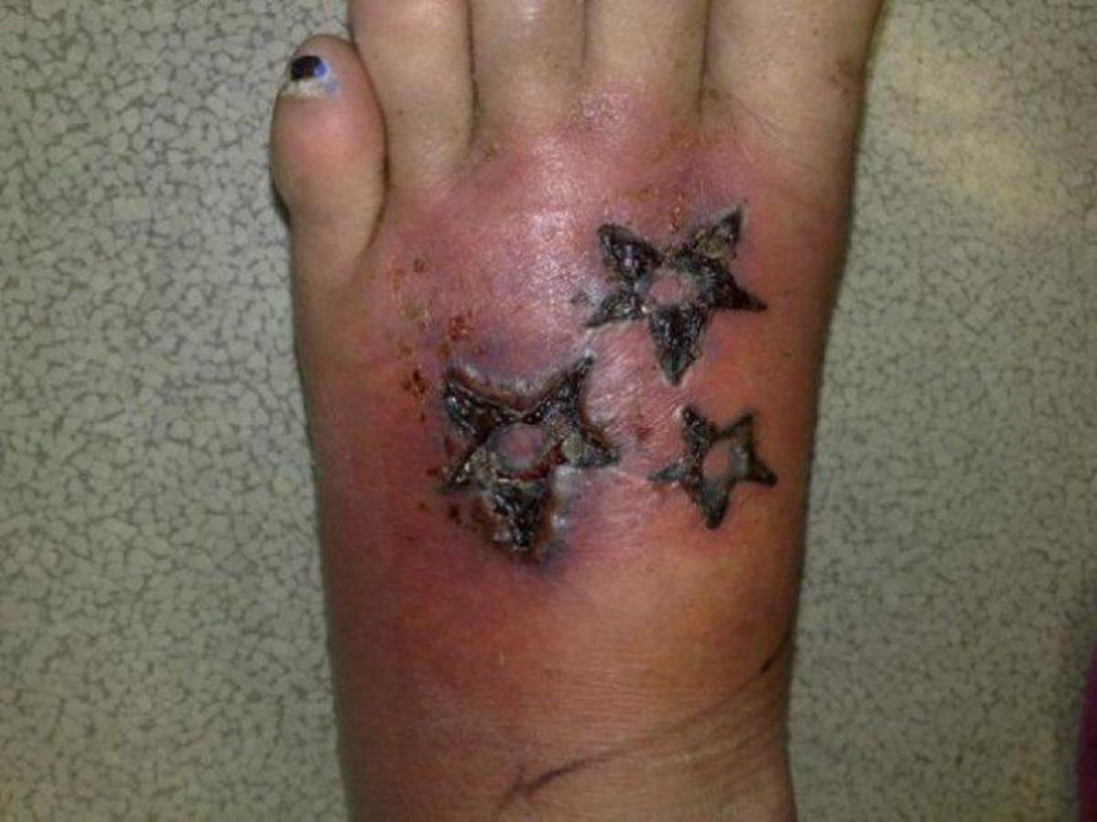 Swollen, infected foot tattoo