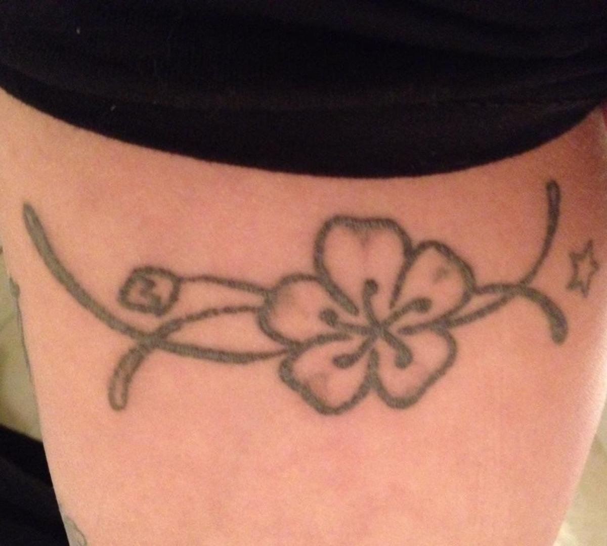 This badly scarred tattoo has had 3 sessions of laser treatment, and will ultimately leave a permanent scar.