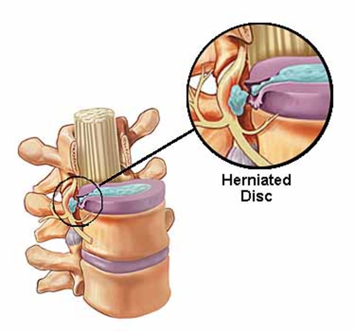 Herniated Disc Treatment Options and My Experience