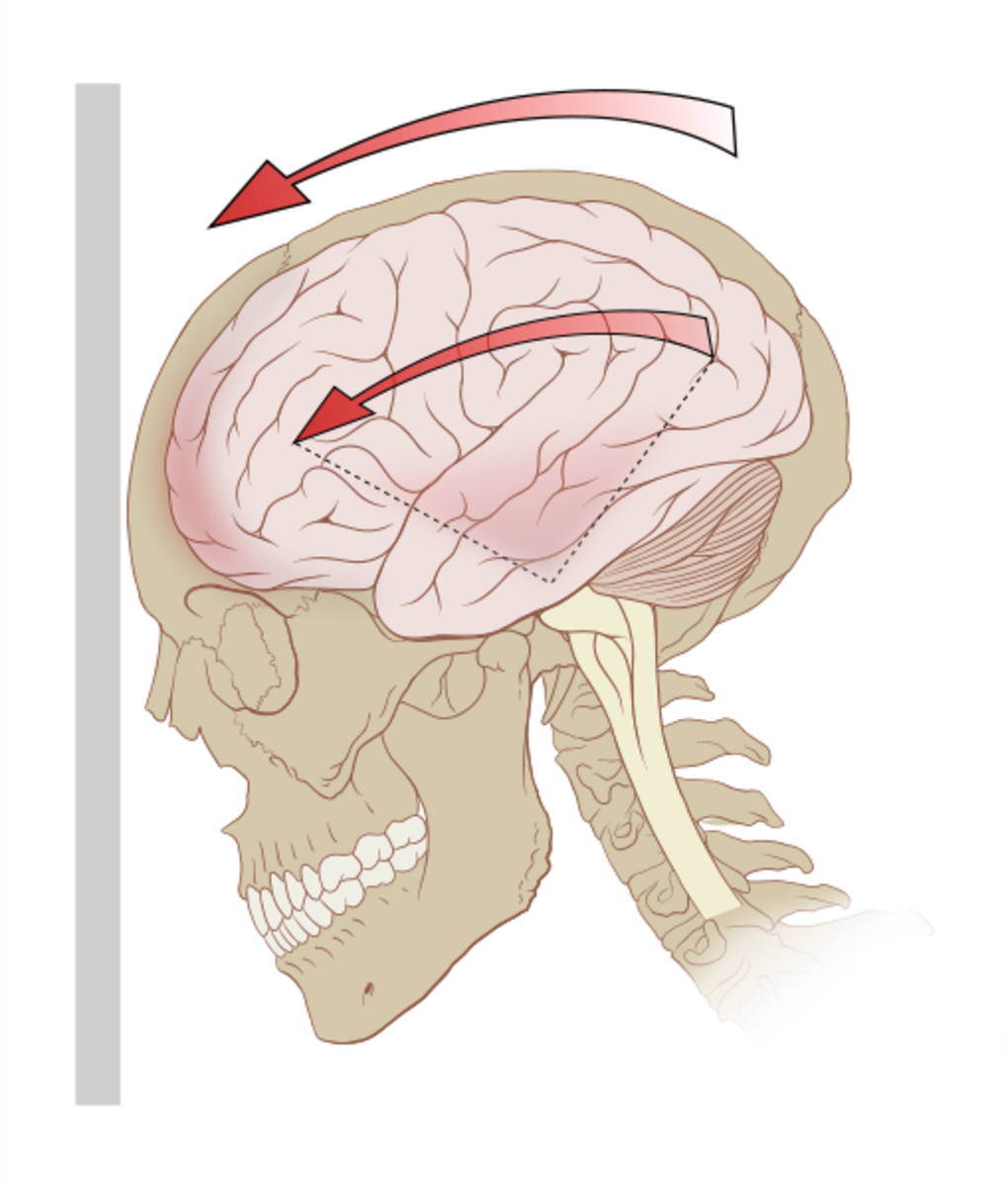 A diagram of the forces on the brain in concussion