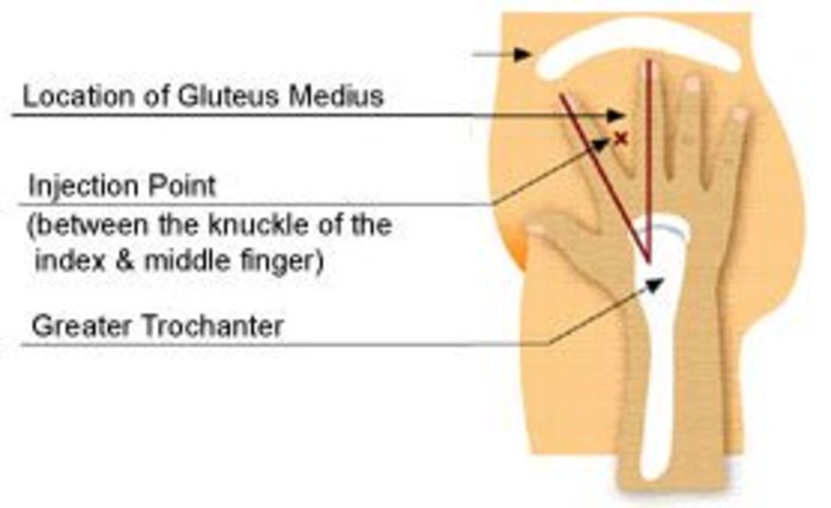 Diagram showing how to locate the ventrogluteal injection site