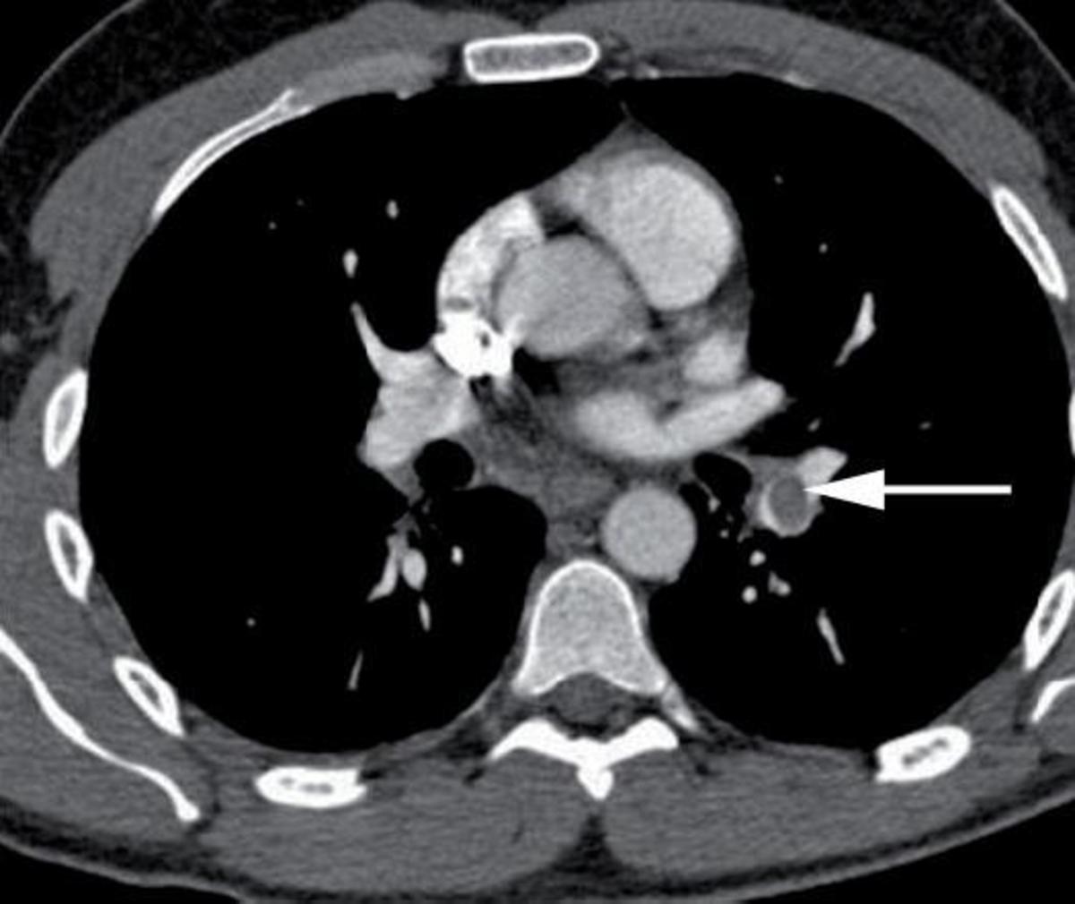 What to Expect During Pulmonary Embolism Recovery