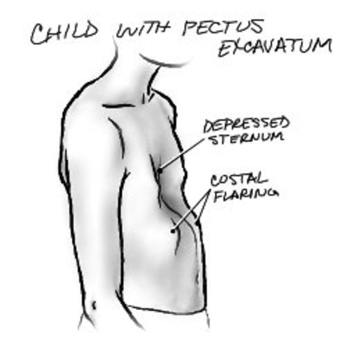 What Is Pectus Excavatum? Growing Up With PE, Causes, Surgery, and Exercise