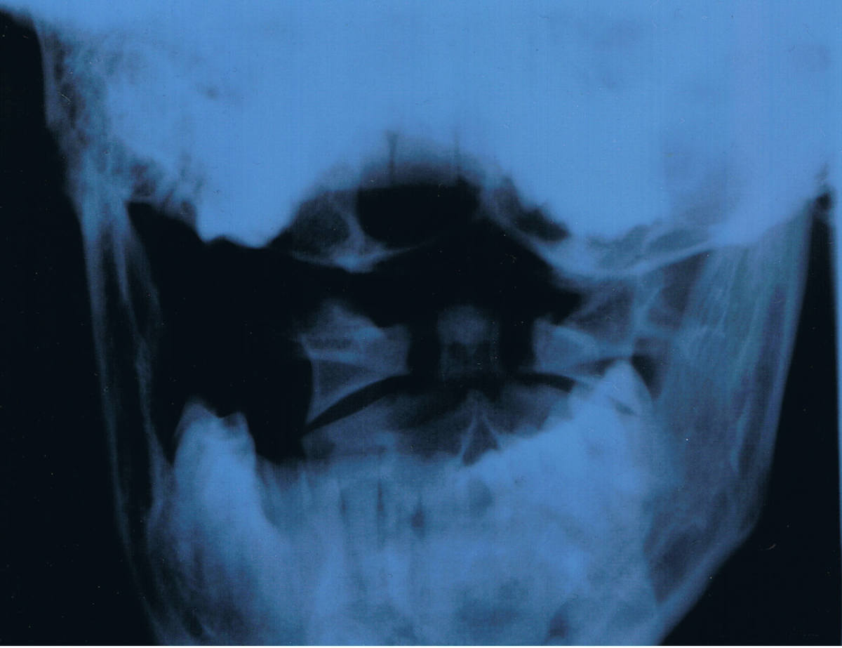 Here is the X-ray of my jaw with the huge gap on one side from the dentist removing my wisdom teeth