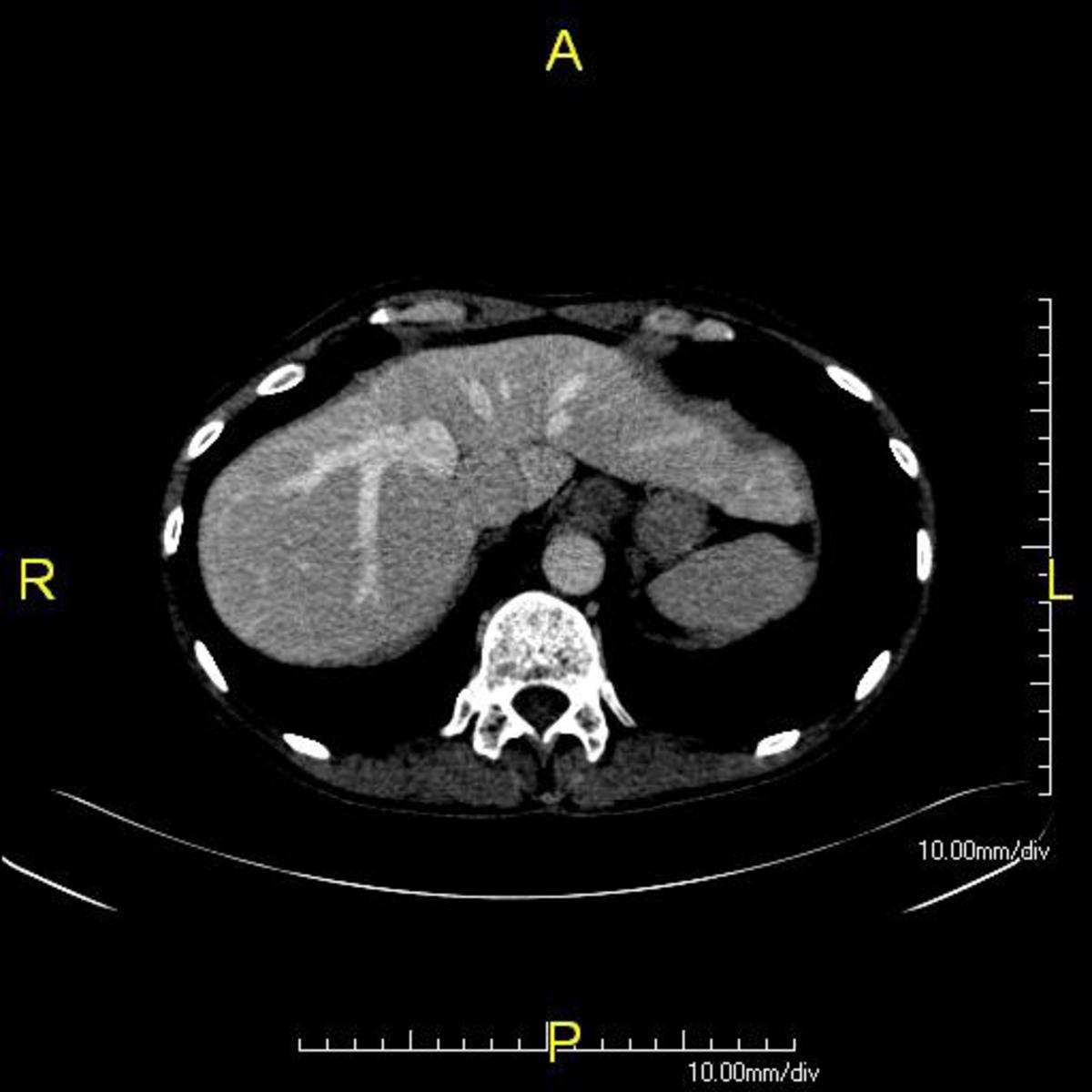 CT scan showing the anterior surface of the liver.