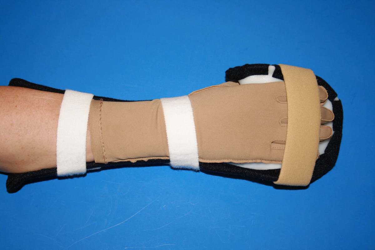 Resting hand splint should cover at least 2/3 of the forearm.  Shown worn with Isotoner glove.  