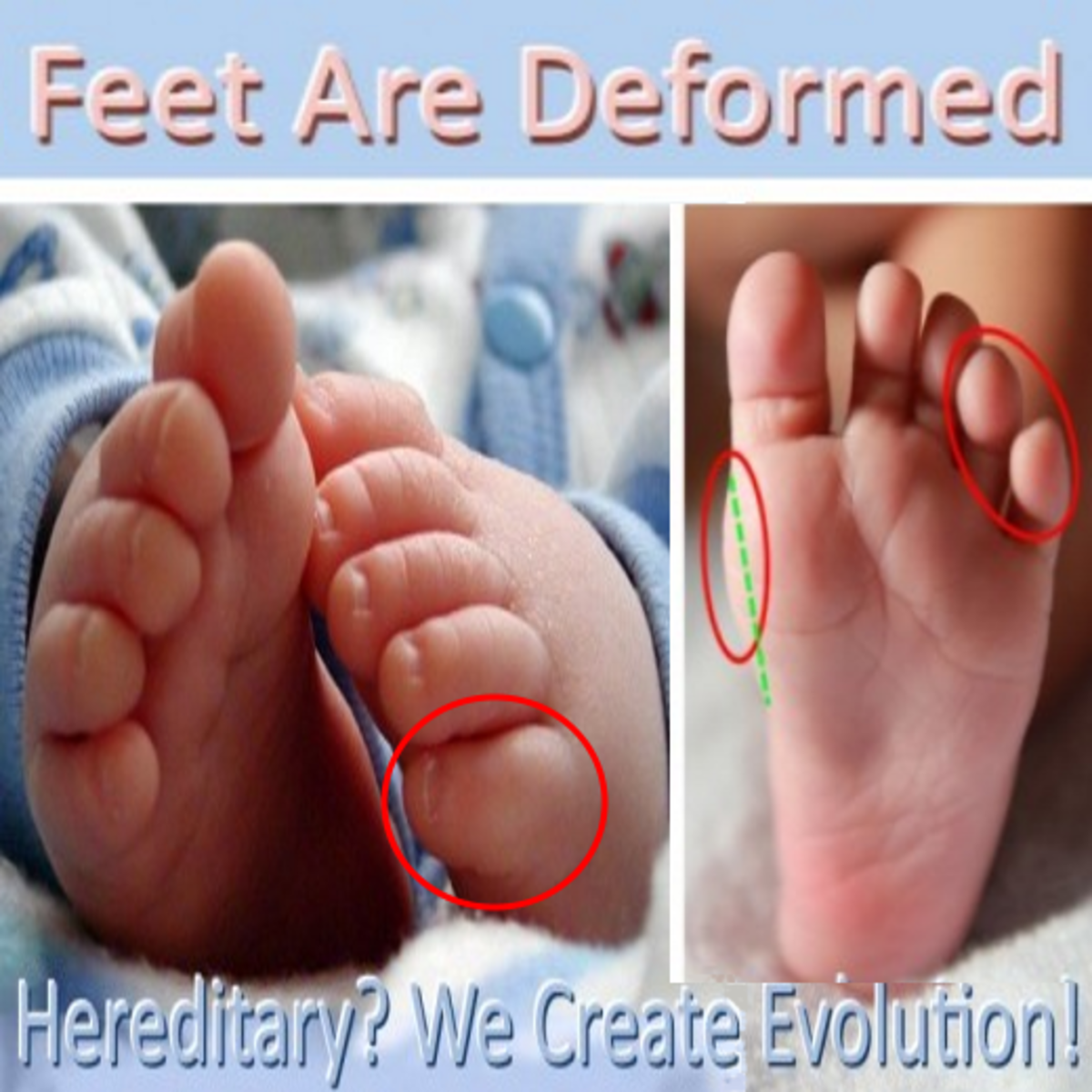 With generations wearing shoes that are not made for the anatomy of a human foot, even babies are born with deformed feet.