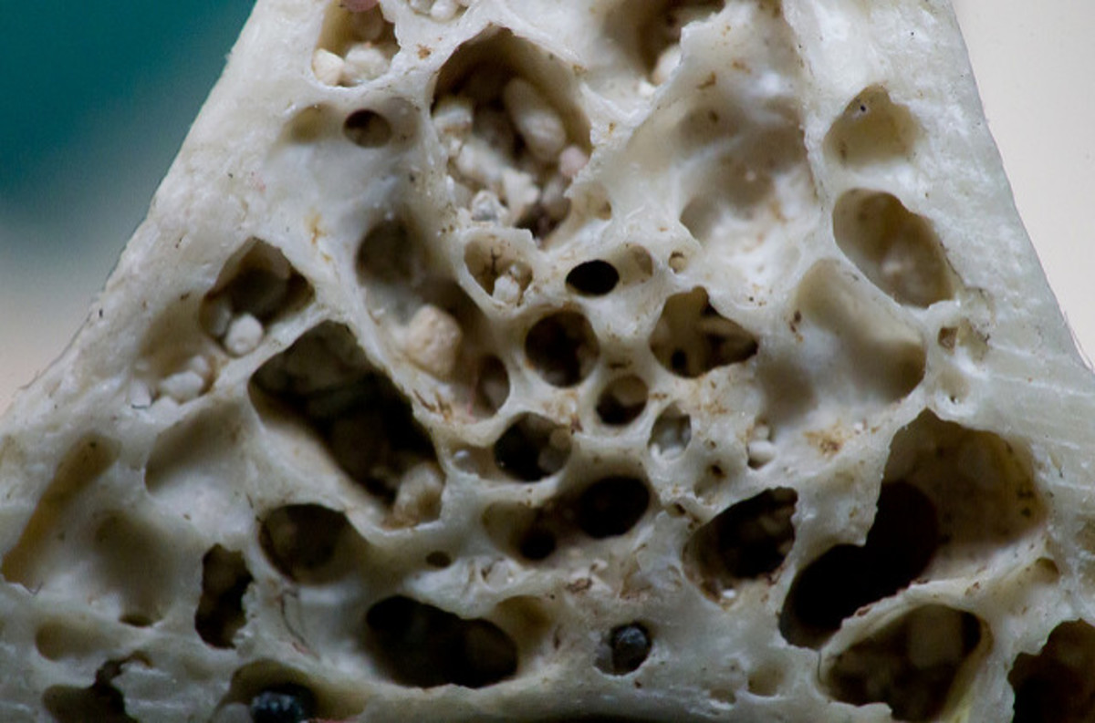 Osteoporotic bone