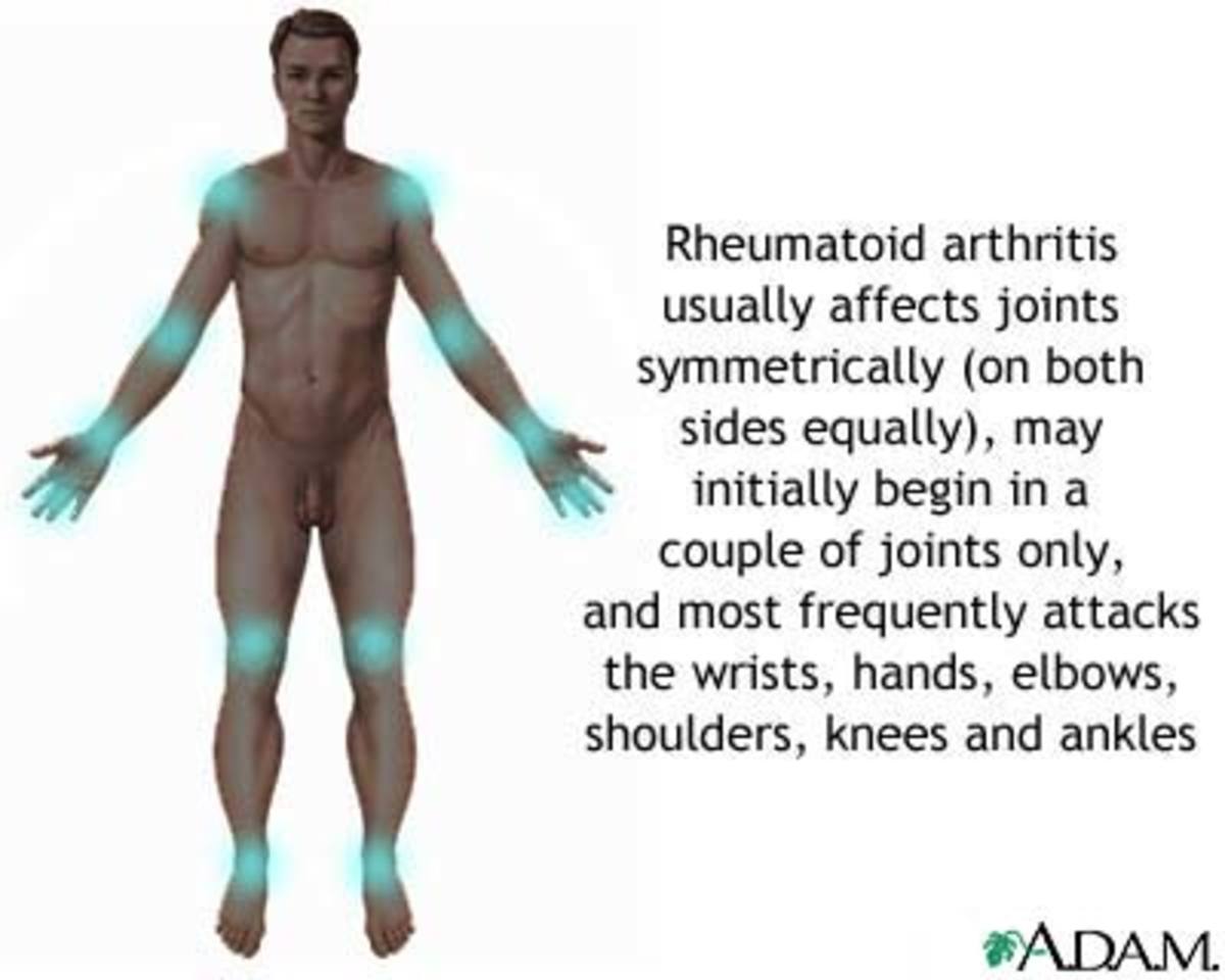 Rheumatoid Arthritis- Battle Inside the Body