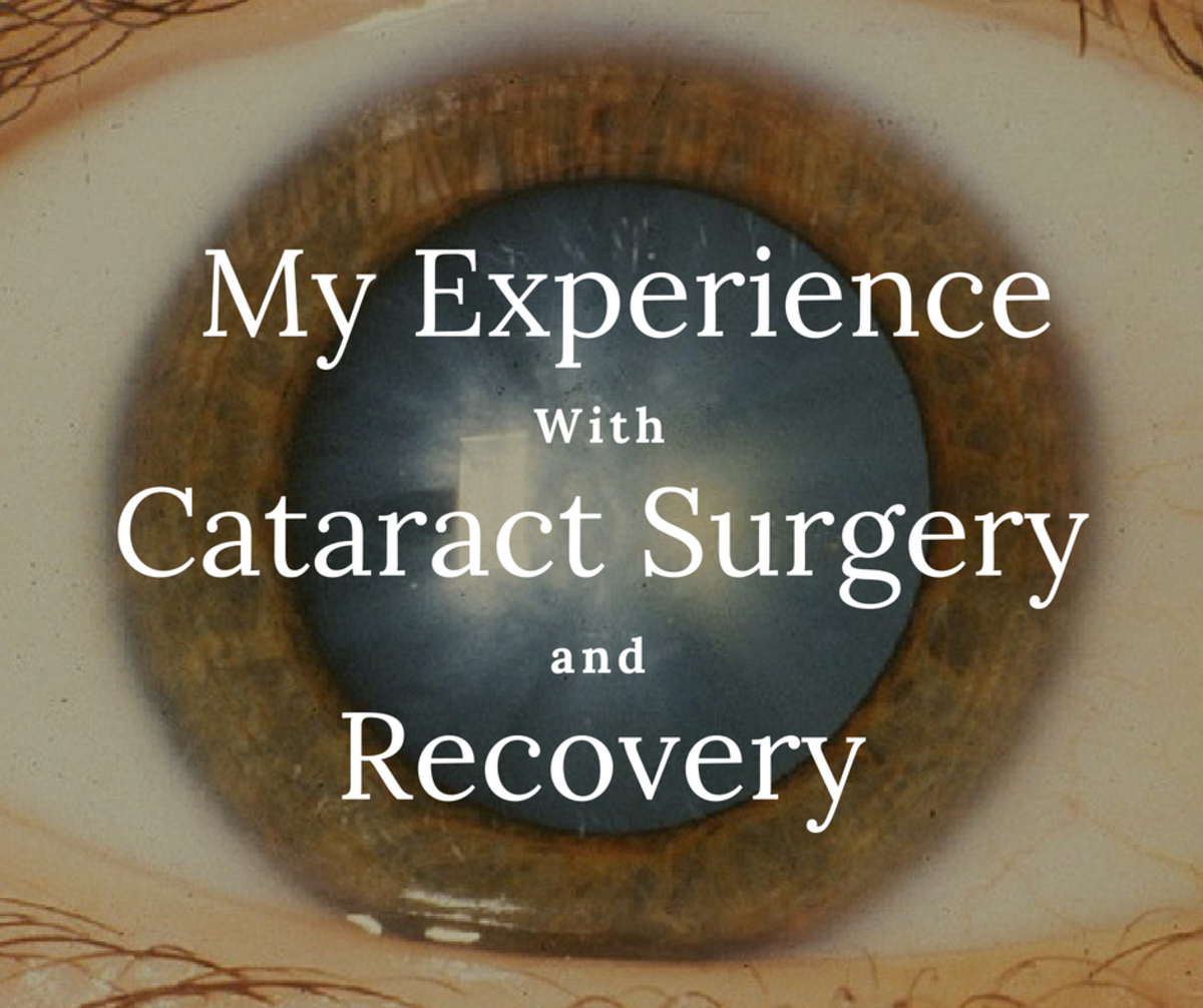 My Experience With Cataract Eye Surgery and Recovery