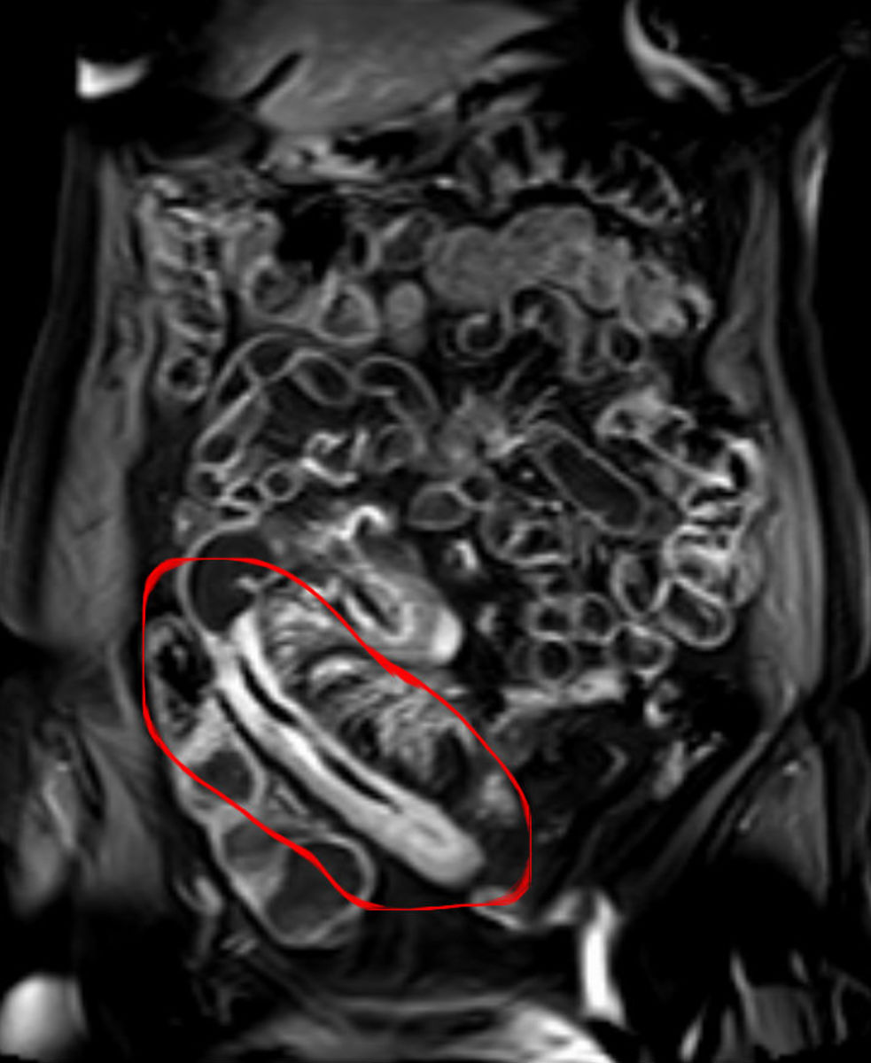 Hypertrophy (increased thickness) of the intestinal wall due to inflammation and scarring.