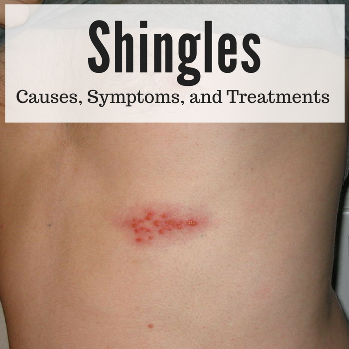 What causes shingles, what are the symptoms, and how is it treated?