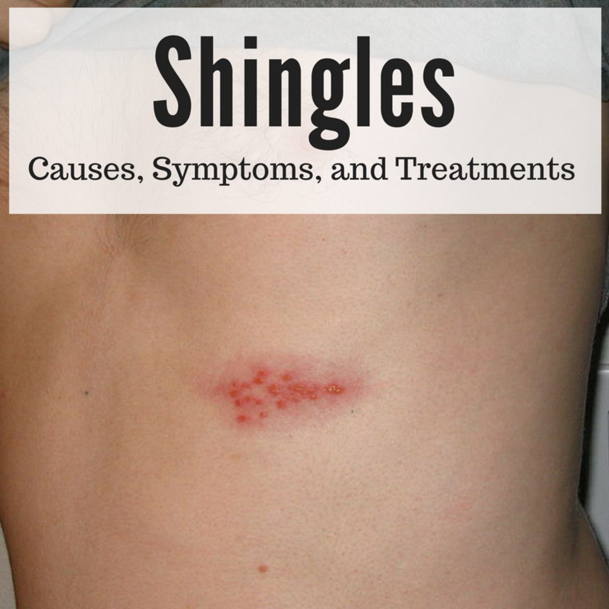 Shingles A Serious And Painful Disease HealthProAdvice