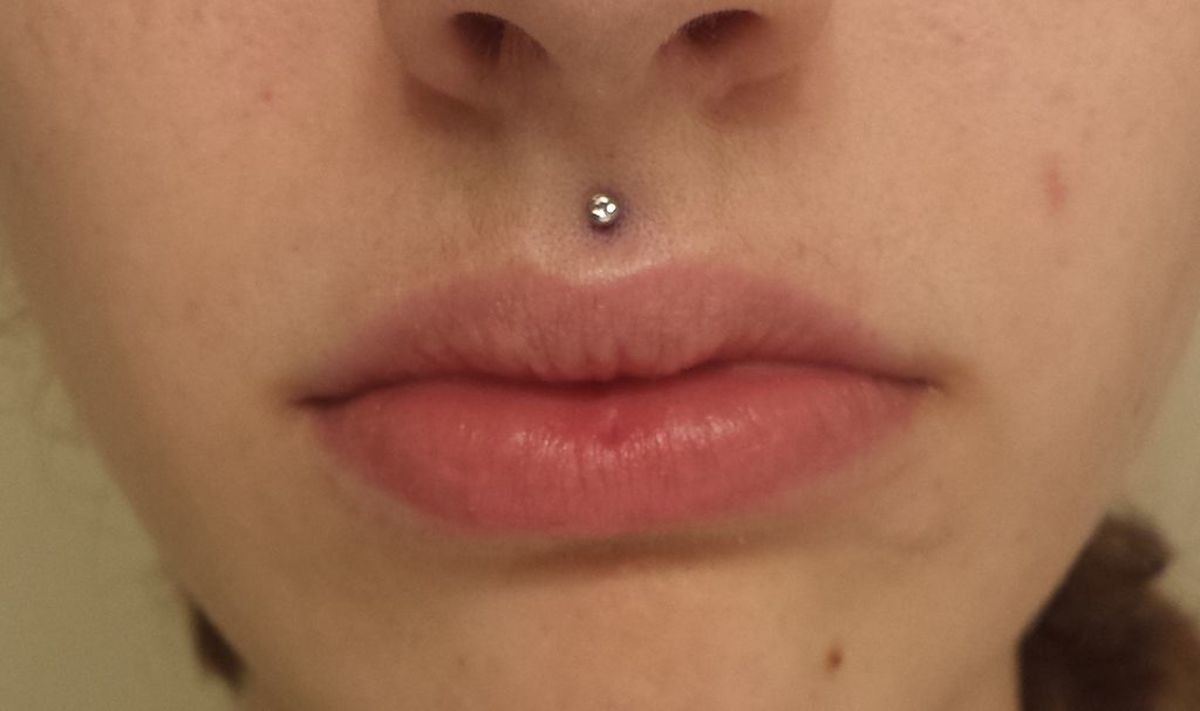 Image of a woman with a fresh philtrum piercing