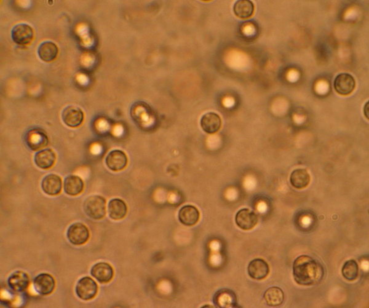 Multiple white cells seen in the urine of a person with a urinary tract infection using microscopy.