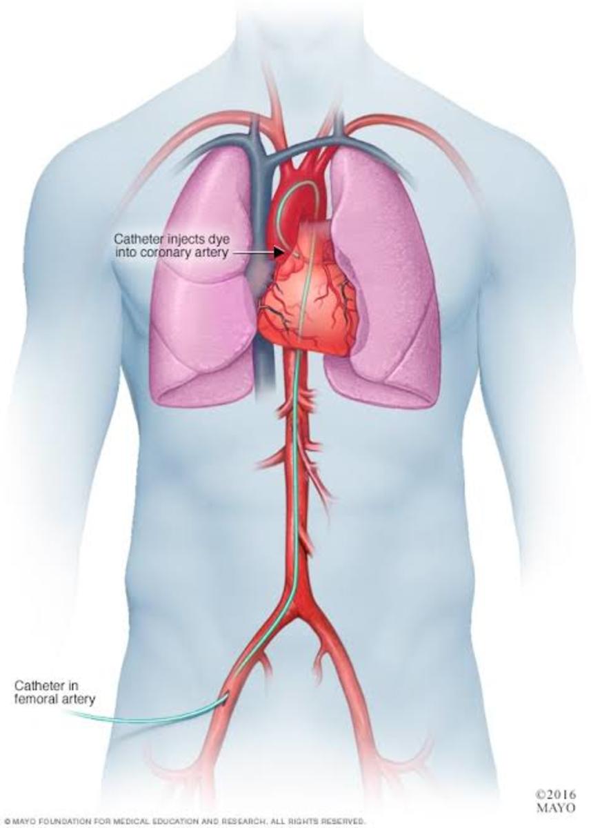 cardiac-catheter-risks