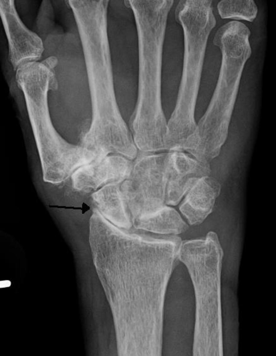 This x-ray image shows severe osteoarthritis in a joint of the hand (indicated by the arrow)
