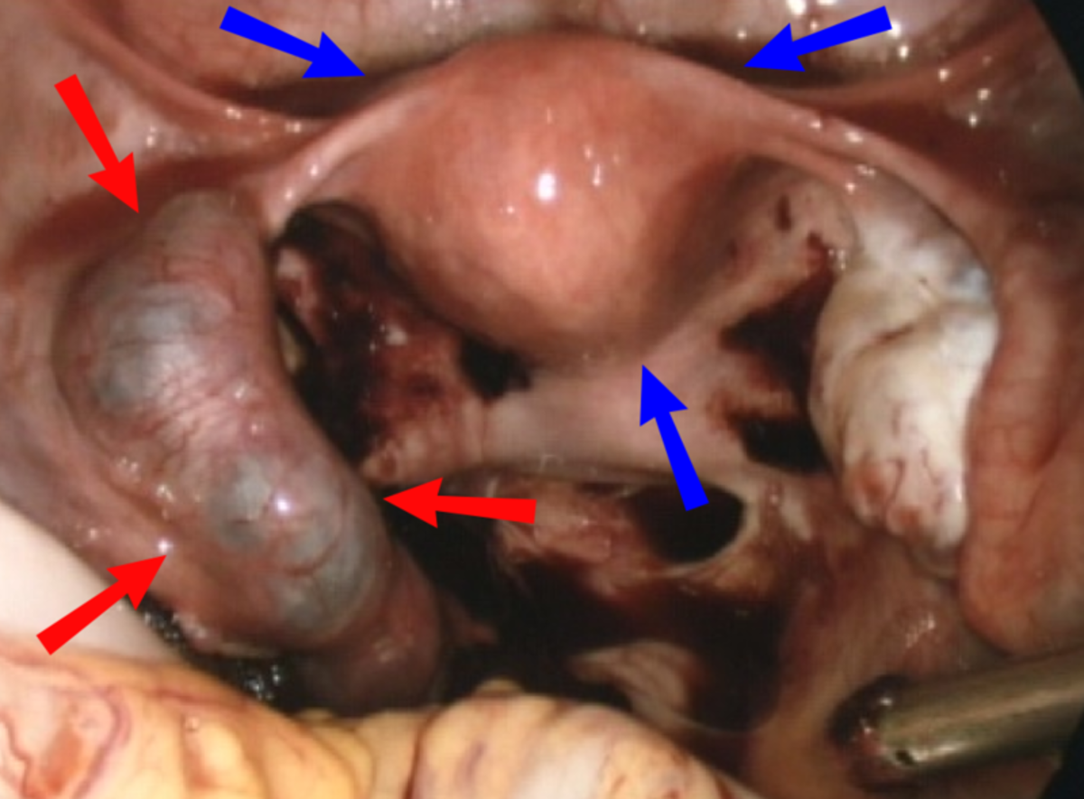 Red arrows point at the flawed fallopian tube. blue arrows point at the uterus.