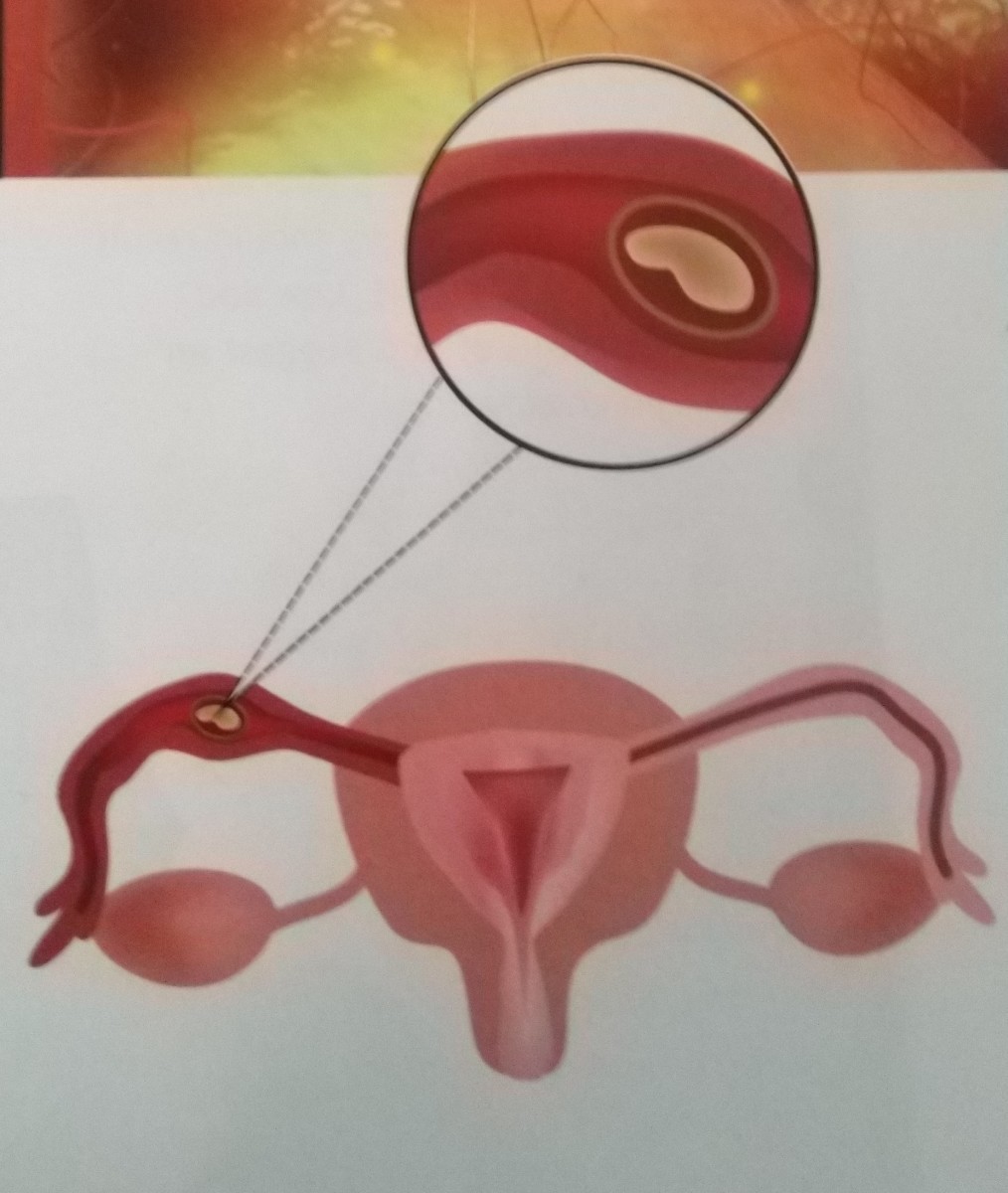 Embryo implanted in fallopian tube