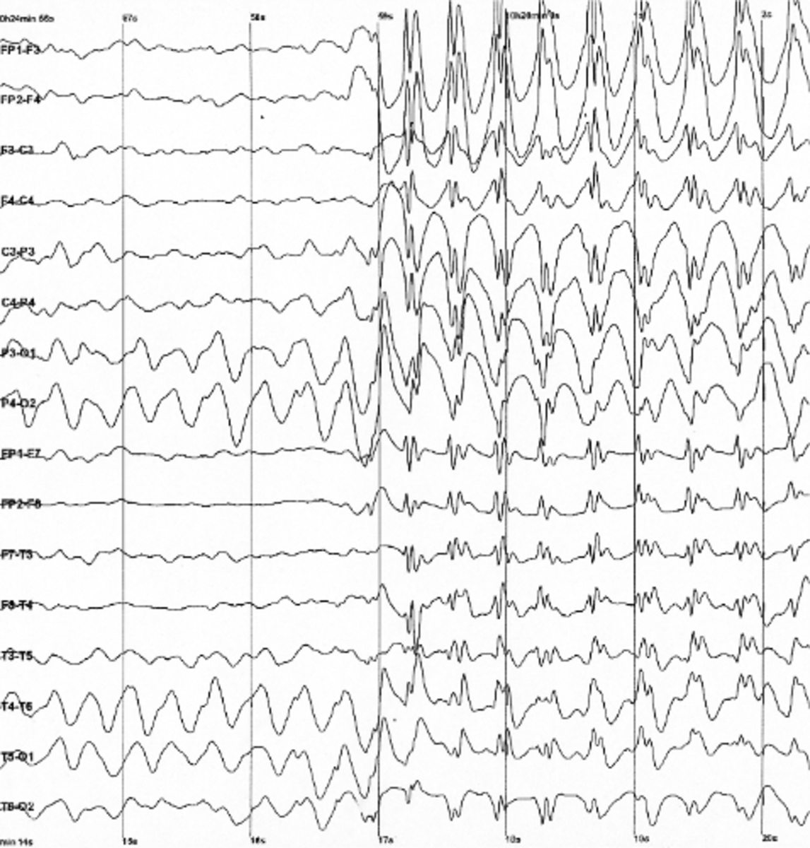 Brain Waves With A Seizure