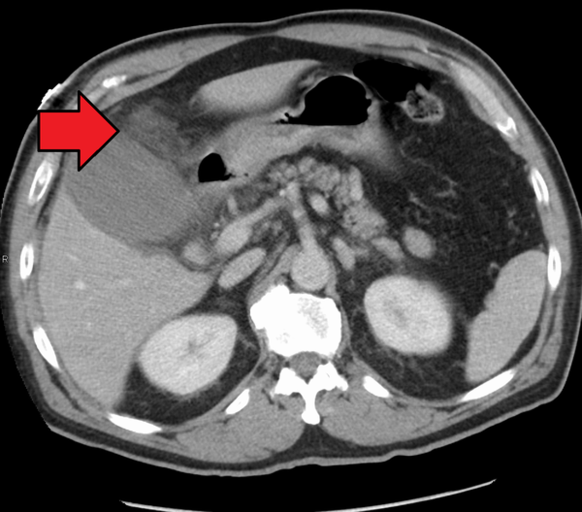 Acute cholecystitis as seen on CT. Note the fat stranding around the enlarged gallbladder. 