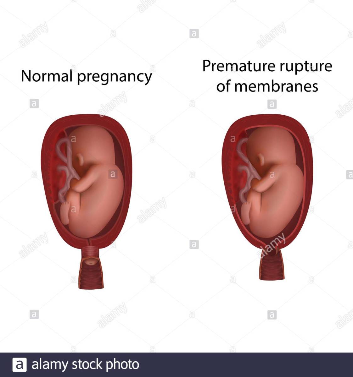 Pprom ( Preterm Premature Rupture of Membrane) at 22 Weeks of Pregnancy