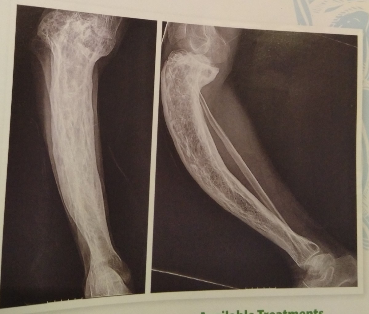 Normal vs. Paget's bone on leg