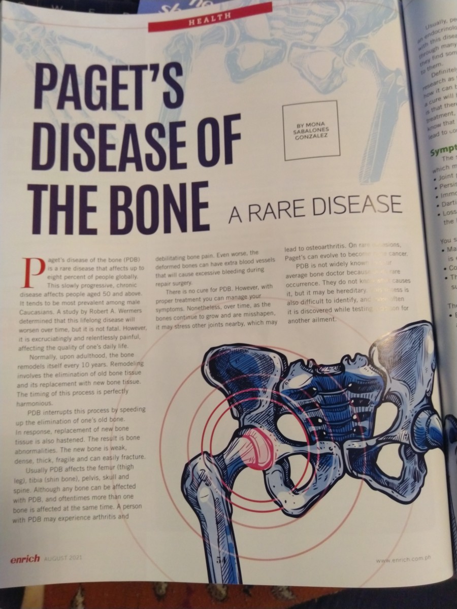 PAGET’S DISEASE OF THE BONE: A Rare Disease