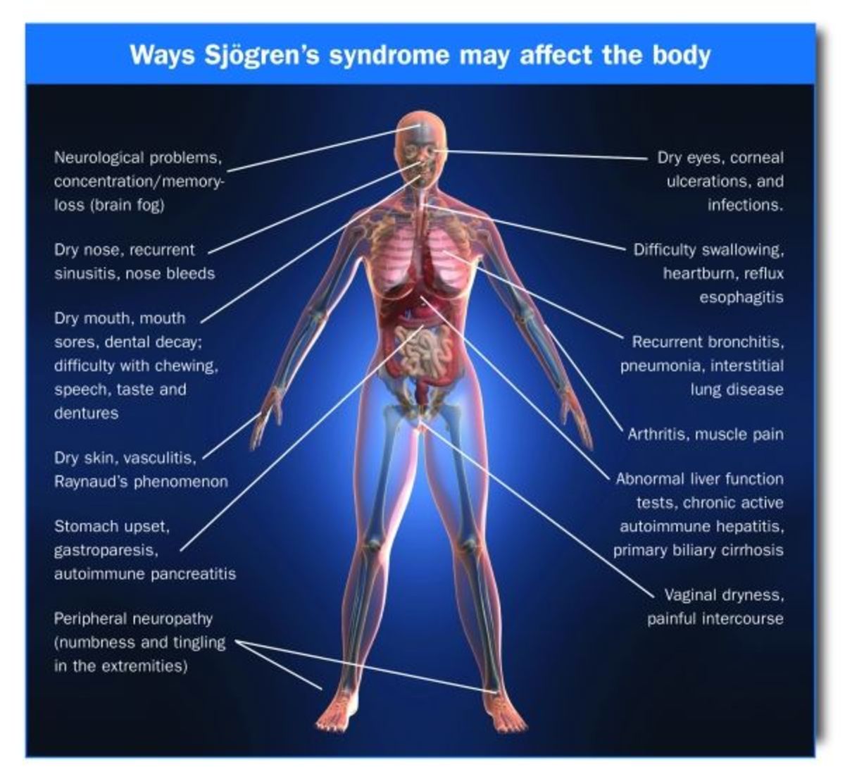 Sjogren's Syndrome. My Experience