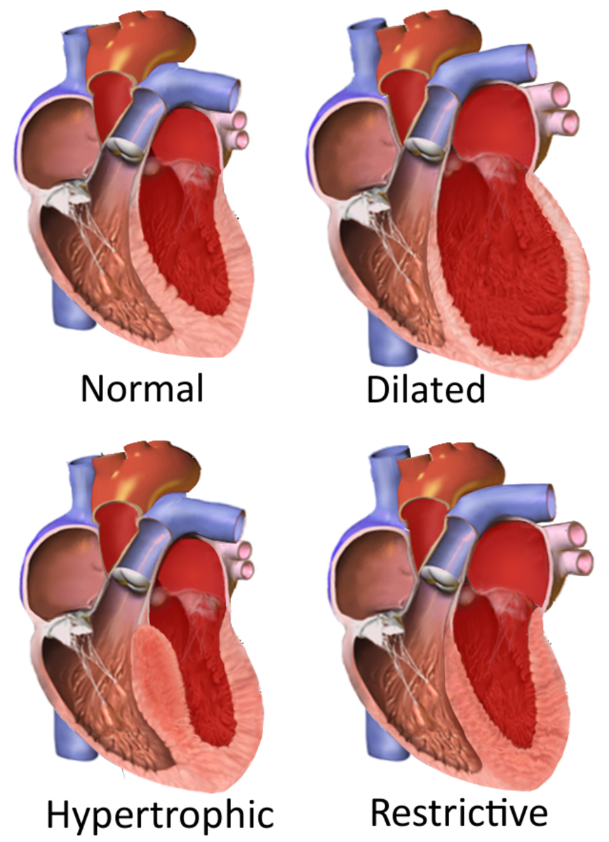 cardiomyopathy-types-and-treatments