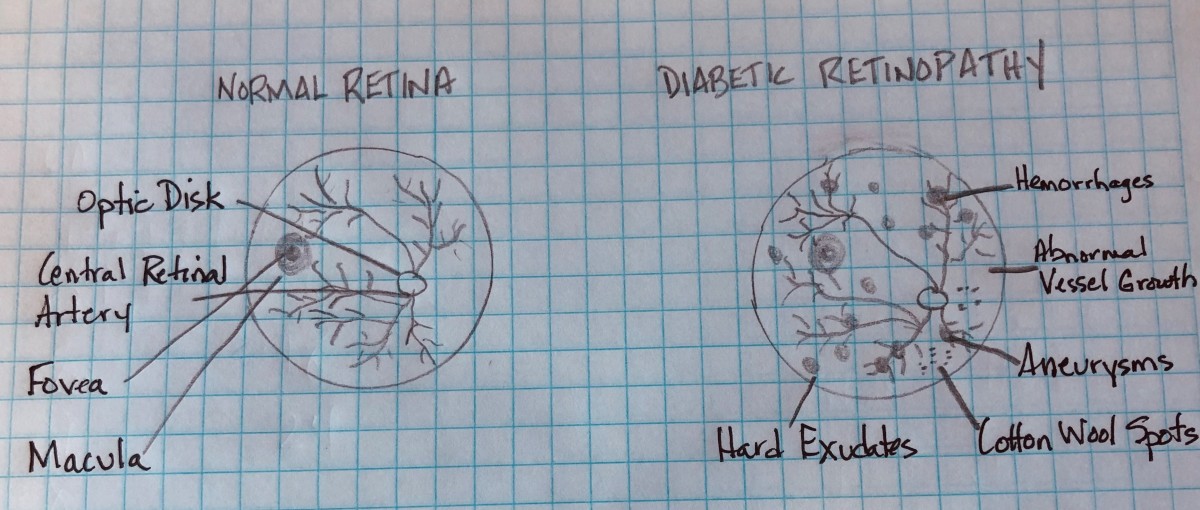Differences between diabetic retinopathy and normal retina
