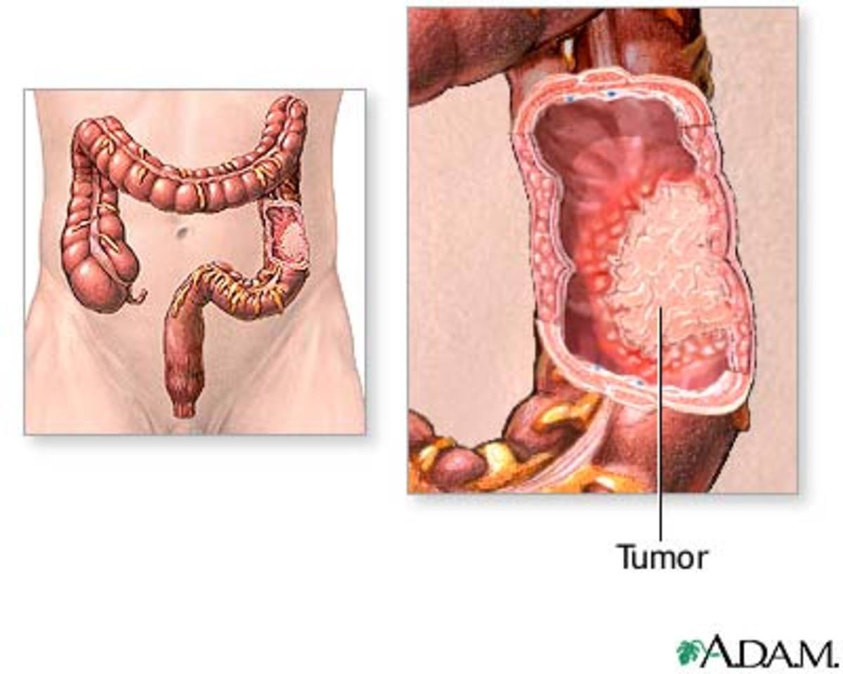 Colon cancer indication
